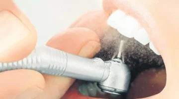Diş çürümesine karşı aşı geliştiriliyor